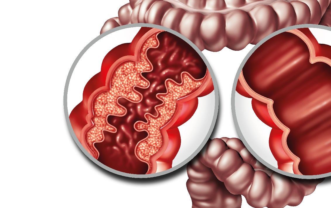 Doença de Crohn Doença de Crohn