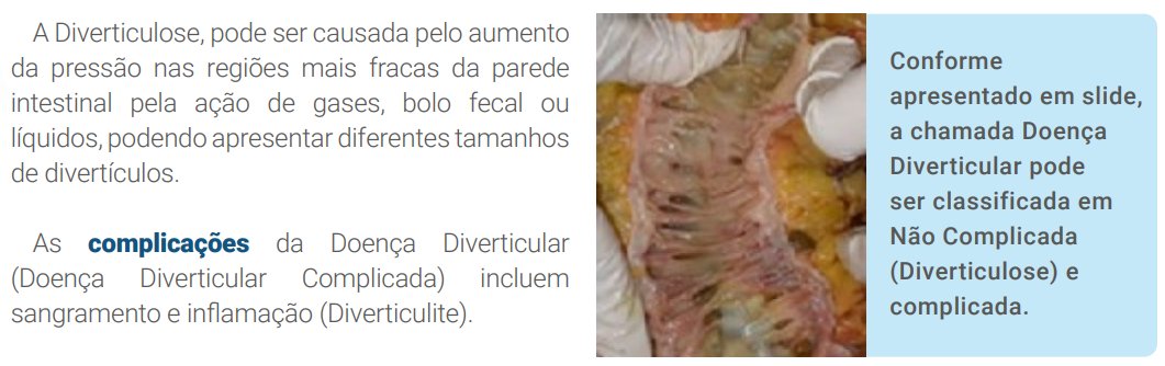 A Diverticulose, pode ser causada pelo aumento da pressão nas regiões mais fracas da parede intestinal pela ação de gases, bolo fecal ou líquidos, podendo apresentar diferentes tamanhos de divertículos. As complicações da Doença Diverticular (Doença Diverticular Complicada) incluem sangramento e inflamação (Diverticulite). 